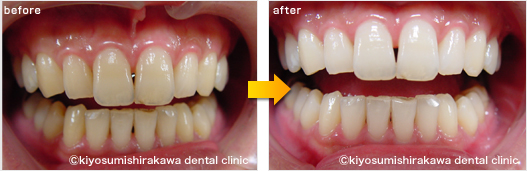 ホワイトニングの症例