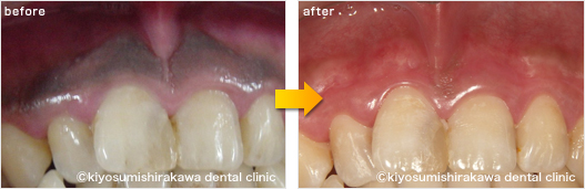 ホワイトニングの症例