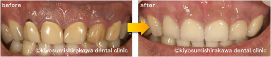 審美歯科の症例