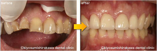 審美歯科の症例