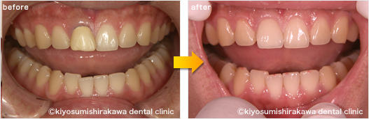 審美歯科の症例