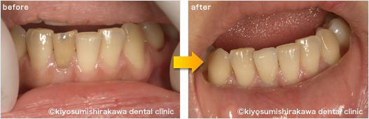 審美歯科の症例