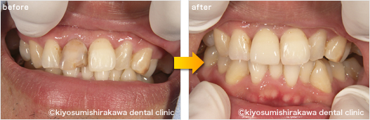 審美歯科の症例