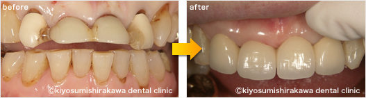 審美歯科の症例