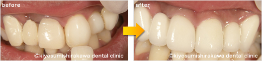審美歯科の症例