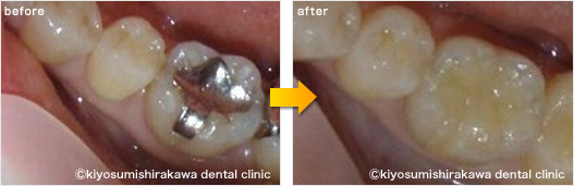 審美歯科の症例