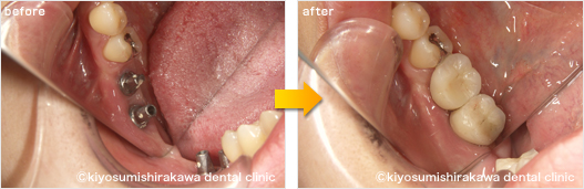 インプラントの症例