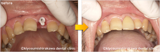 インプラントの症例