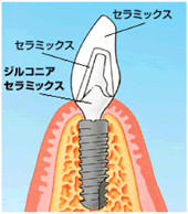 オールセラミックスのインプラント治療