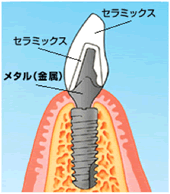 オールセラミックスのインプラント治療