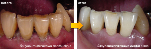 歯周病の症例1